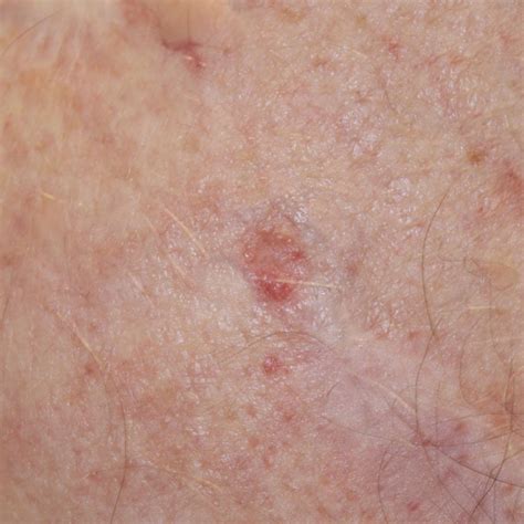 Basal Cell Skin Cancer Moles