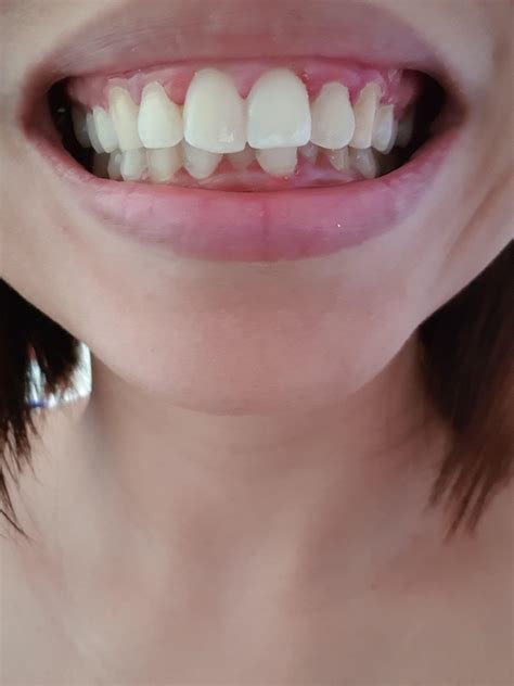 How To Fix An Overbite Naturally Reddit Mewing With An Overbite 5
