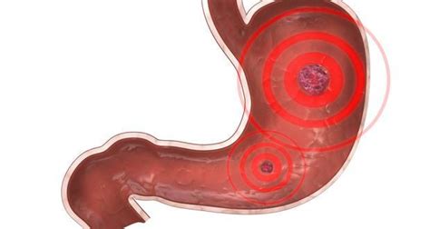 Peptic Ulcer Causes Symptoms Diagnosis Treatment And Prevention
