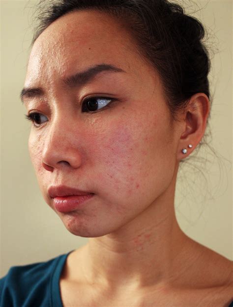 Allergic Reaction Face Pictures Photos