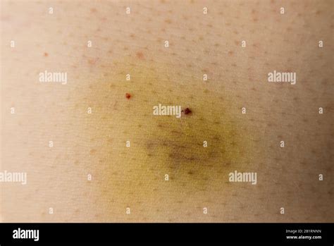 Close Up On A Bruise On The Skin Medical Concept Stock Photo Alamy