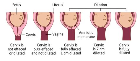 What Is Dilation In Pregnancy American Pregnancy Association