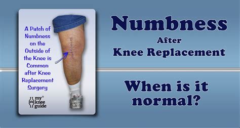 Knee Numbness A Common Post Operative Finding Knee Replacement Knee Replacement Recovery