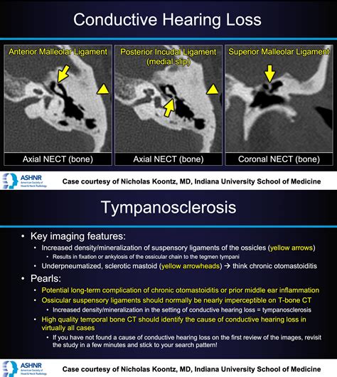 Tympanosclerosis