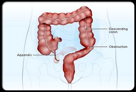 I have a problem with my appendix. Appendicitis & Appendectomy Pictures ~ Your doctor