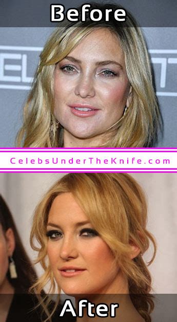 Kate Hudson Cosmetic Surgery Photos Before After
