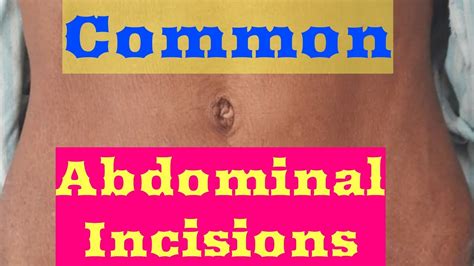 Common Abdominal Incisions Youtube
