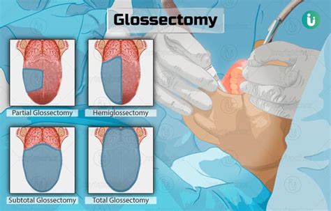 Glossectomy Procedure Purpose Results Cost Price