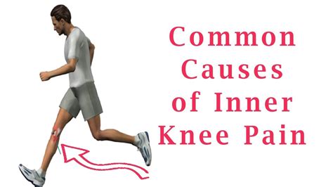 Inner Knee Pain Common Causes Of Inner Knee Pain Youtube