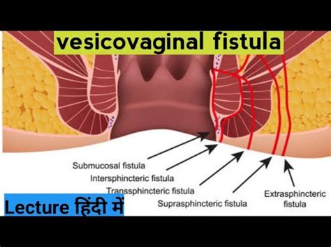 Vesico Vaginal Fistula Youtube