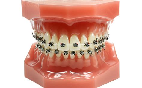 How Much Do Braces Cost A Comprehensive Guide