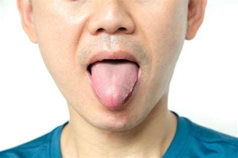 How To Cure Tongue Burn After Smoking Up? - GrowDiaries