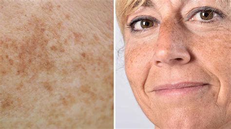 最も共有された！ √ Old Age Spots On Skin 194038 How Do I Get Rid Of Old Age