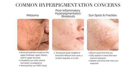 How To Get Rid Of Hyperpigmentation And Dark Spots Treatment Plan — Derm