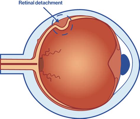 Retinal Detachment Symptoms Causes And Operation Oftalvist