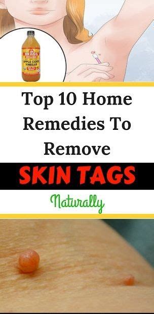 top 10 home remedies to remove skin tags naturally skin tag removal remove skin tags