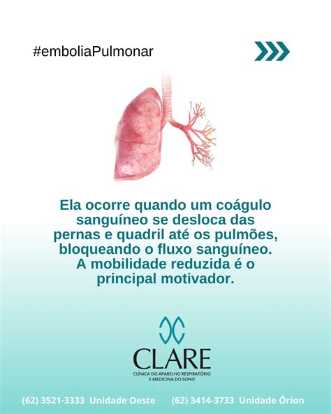 O Que Embolia Pulmonar Veja Causas Sintomas E Tratamentos Cl Nica Clare