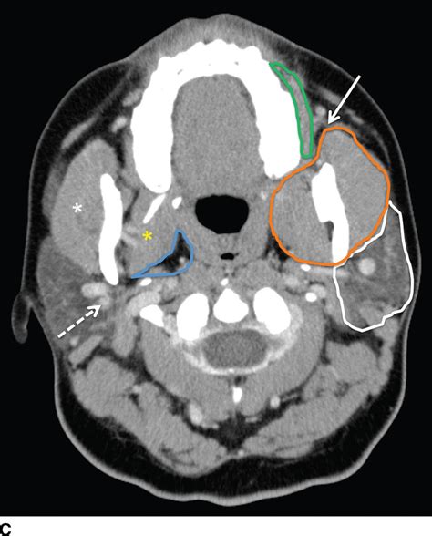 Ct Scan Of The Head And Neck Showing Left Parotid Gland Mass Arrow My Xxx Hot Girl