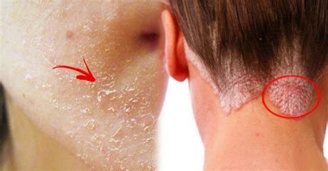 Trending Now Experiencing Dry Skin And Hair Loss This Might Be
