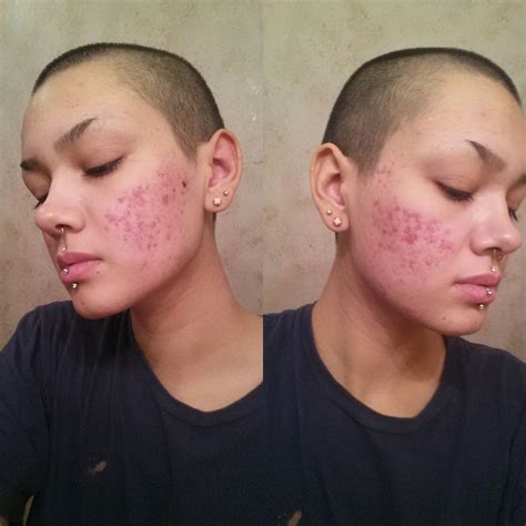 Finally Found A Natural Cure For My Hormonal Acne Hormonal Acne By