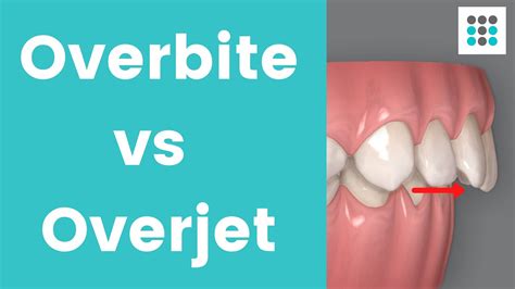 Difference Between Overbite And Overjet Differences Finder