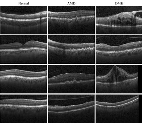 Retinal Oct Disease Classification Papers With Code