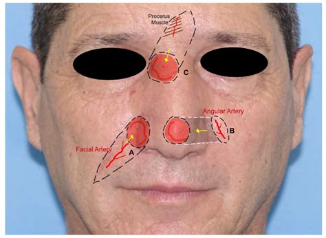 Facial Artery Based Flap A Nasolabial Flap With Evidence Of The