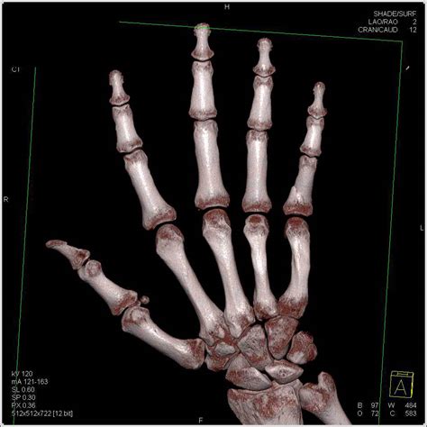 Fracture Proximal Phalanx 5th Digit - Trauma Case Studies ...