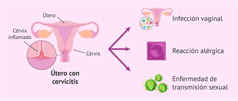 ¿cómo Se Cura La Cervicitis