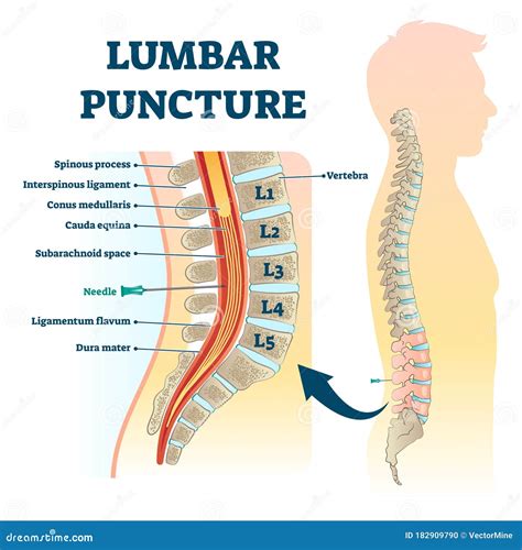 Lumbar Puncture Vector Illustration Labeled Spine Structure Procedure