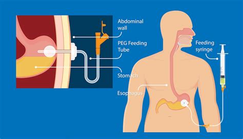 Feeding Tubes — What You Should Know Roswell Park Comprehensive