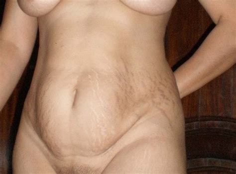 Nude Moms With Stretch Marks