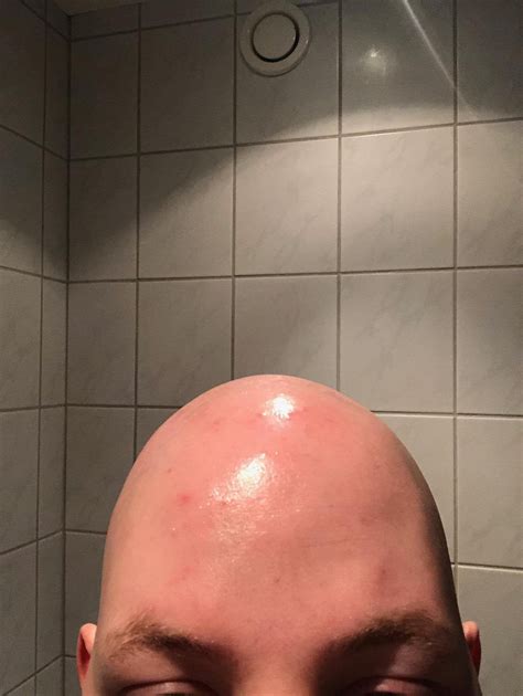 [acne] bald male 25 acne on scalp please help skincareaddiction