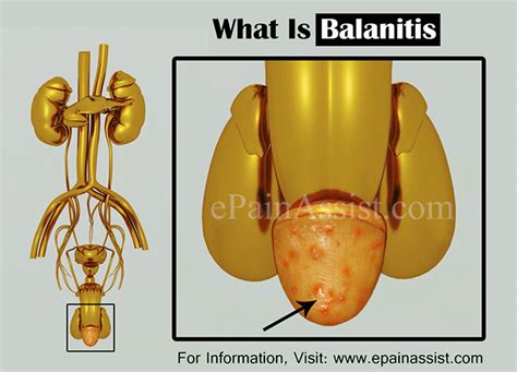 What Is Balanitis Know Its Treatment Causes Symptoms Home Remedies