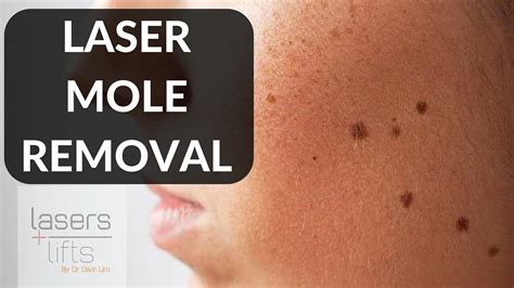 Sporting a few moles doesn't necessarily mean that you must forego hair removal via razor, laser, or chemical depilatories; LASER MOLE REMOVAL - YouTube