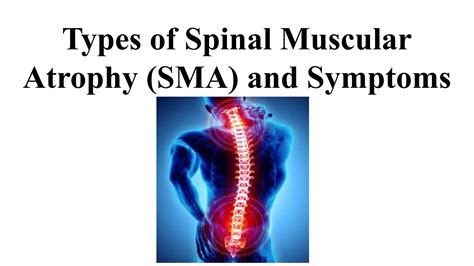 Types Of Spinal Muscular Atrophy Sma And Symptoms By Shravanp Issuu