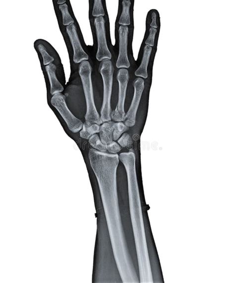 X Ray Of Human Hand Stock Photo Image Of Bony Check 94157202