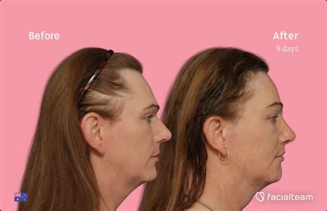 Kate Before And After Ffs Surgery — Facialteam