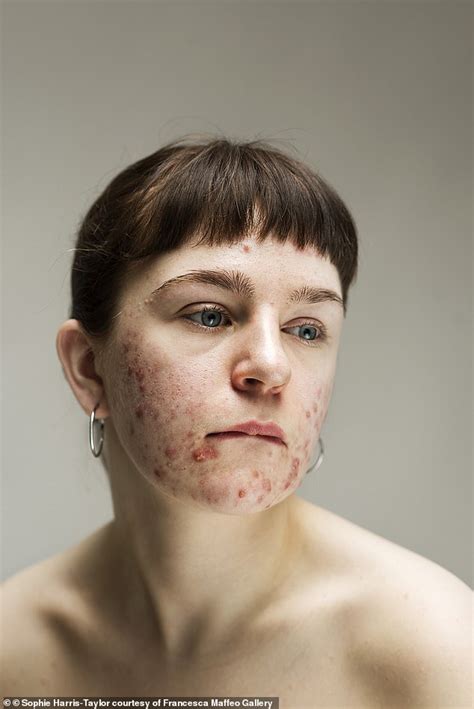Women With Skin Conditions Like Acne Eczema And Rosacea Pose Make Up Free Daily Mail Online