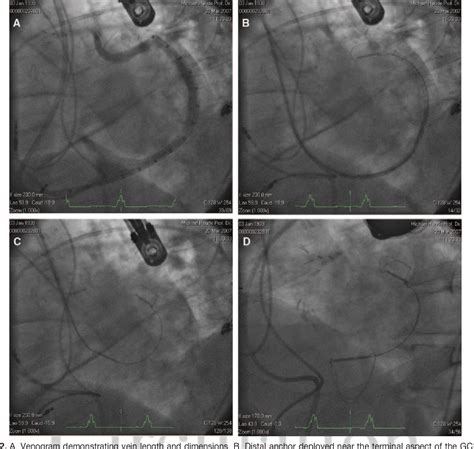 Figure 2 From Percutaneous Mitral Annuloplasty For Functional Mitral