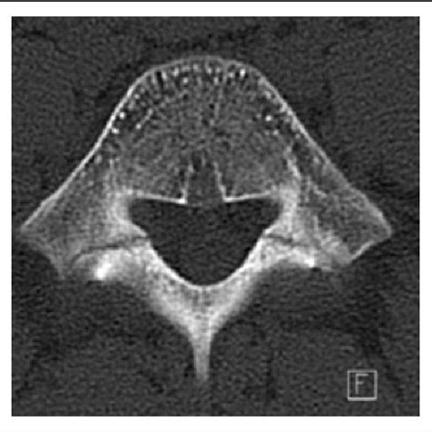 Pdf The Incidence Of Pars Interarticularis Defects In Athletes