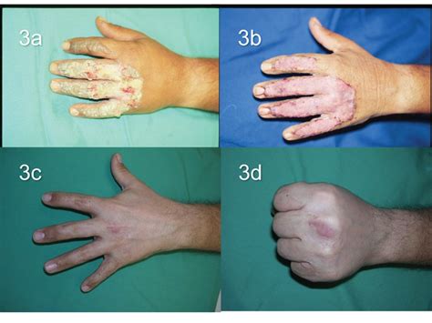 How To Cure Third Degree Burns Partskill30