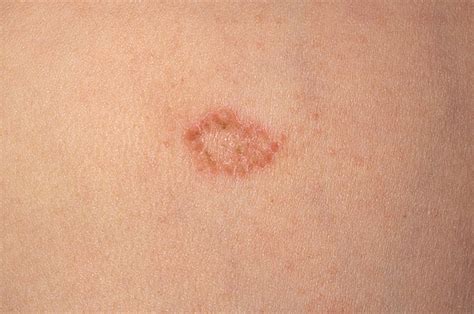 Dermnet Eczema Pictures Photos