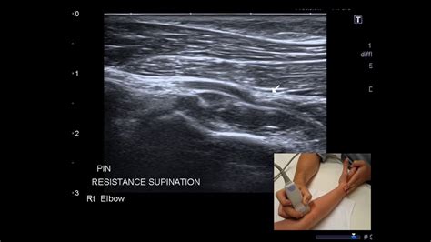 Ultrasound Entrapment Of The Pin Radial Nerve Forearm Elbow Youtube