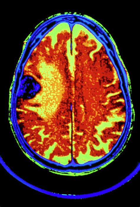 Coloured Ct Scan Of Metastatic Brain Cancer Photograph By Gcascience