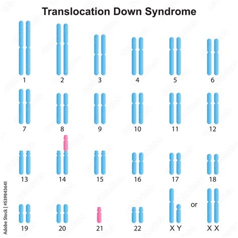 Scientific Designing Of Robertsonian Translocation Down Syndrome