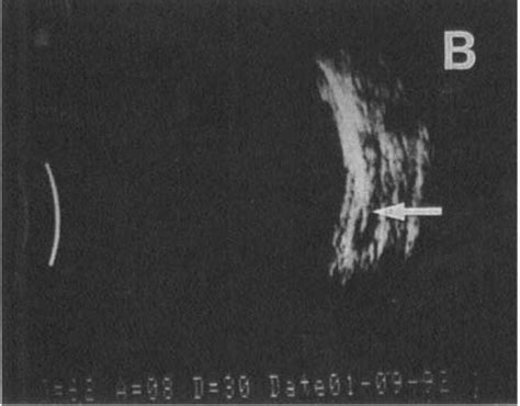 Normal B Mode Echographic Appearance Of Extraocular Muscle The Probe