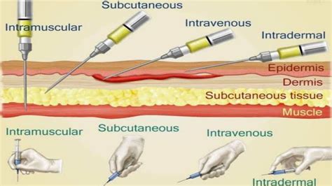 Injection Techniques Intramuscular Intravenous Intradermal