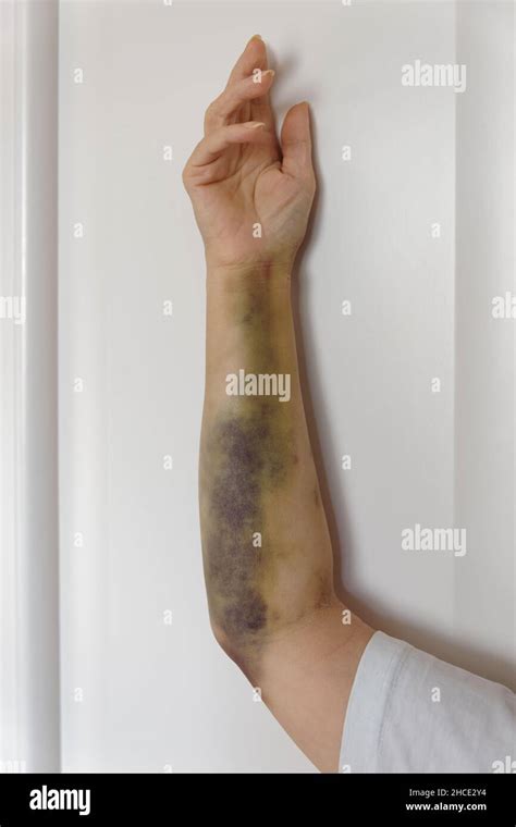 Severe Arm Bruising After Coronary Angioplasty In Female Patient Stock