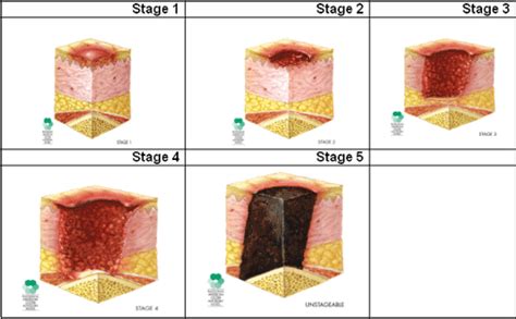 Describe The Stages Of Pressure Ulcers